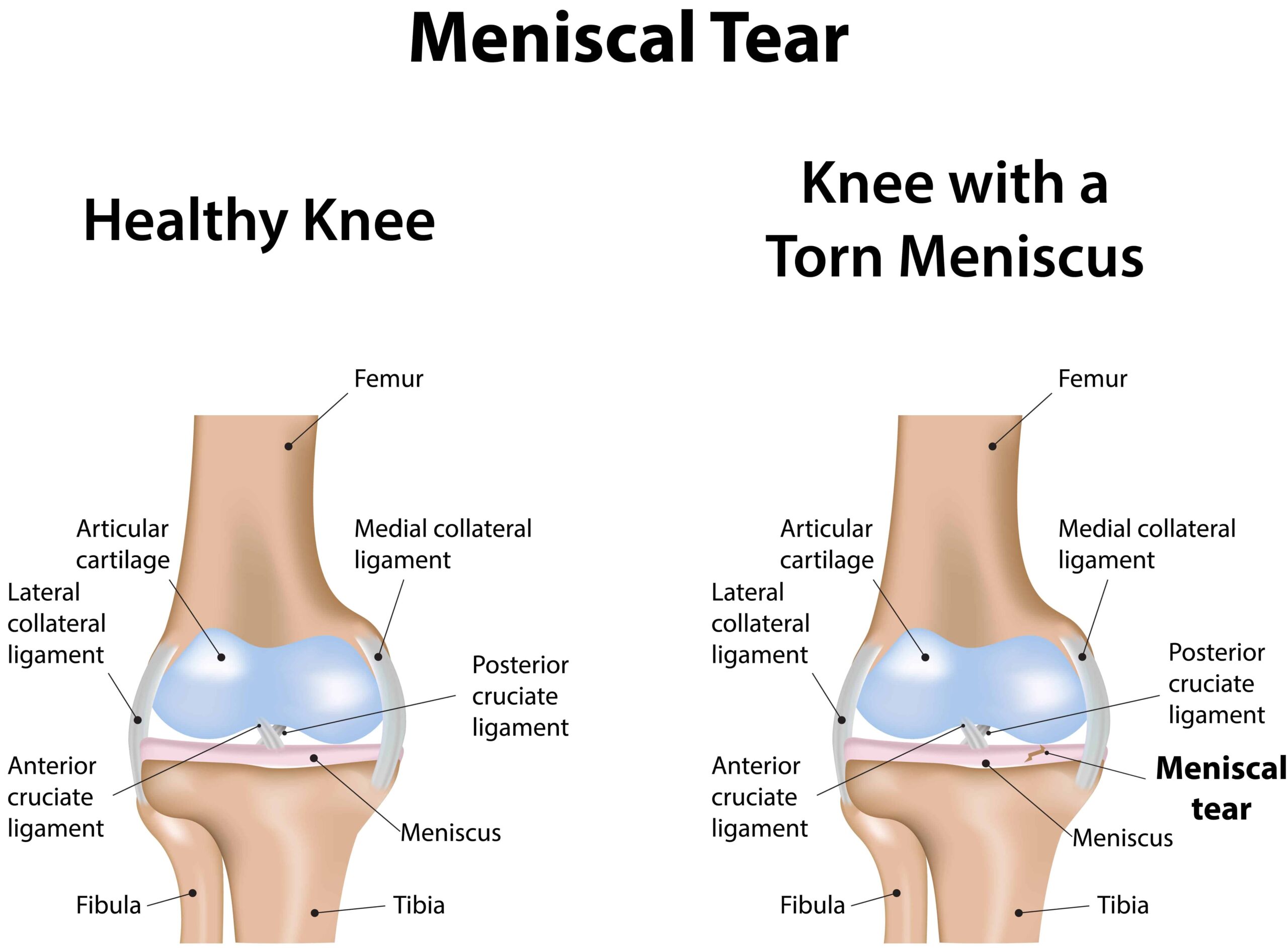 Meniscus Tear - Mississauga Chiropractor and Physiotherapy ...