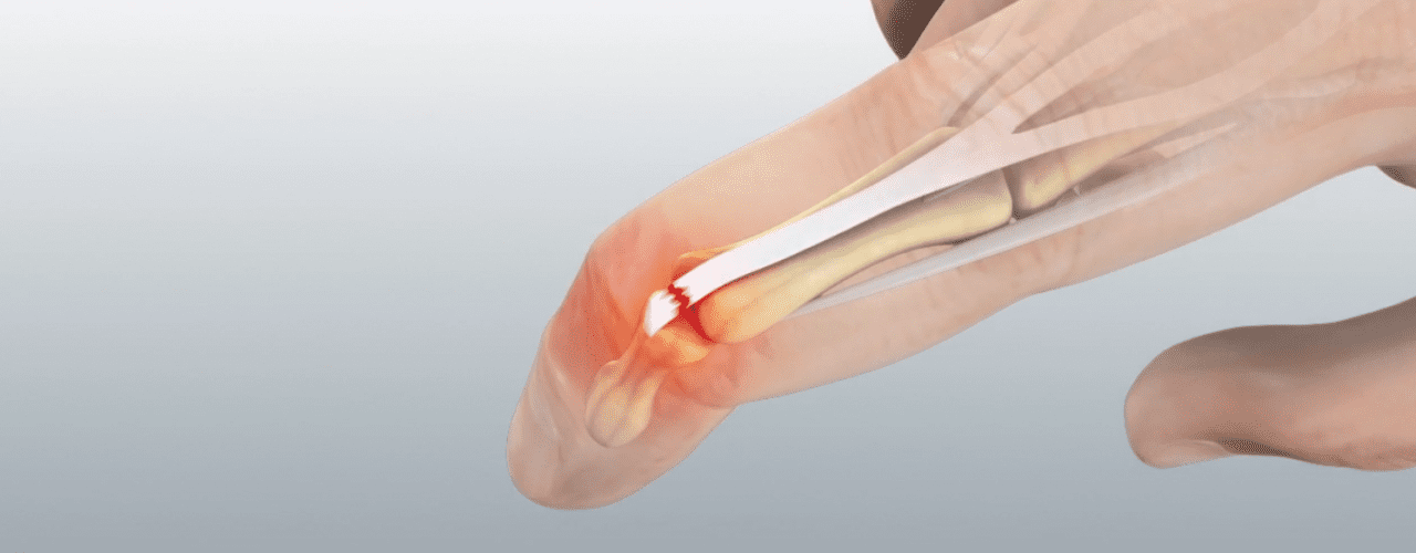 What is Mallet Finger? Mississauga and Oakville Chiropractor and