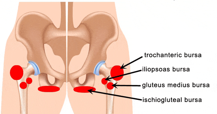 Related image for hip bursitis