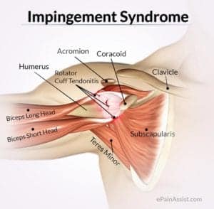Impingement Syndrome