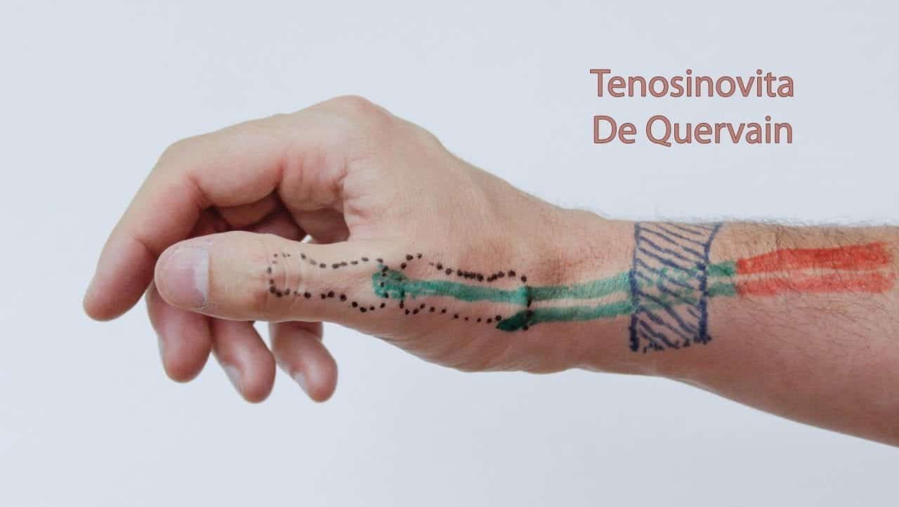 De Quervain’s Tenosynovitis - Mississauga and Oakville Chiropractor and ...