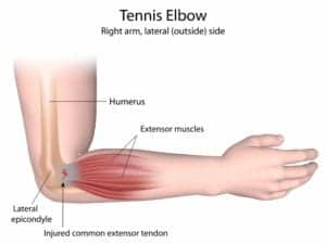 Tennis Elbow (Lateral Epicondylitis)