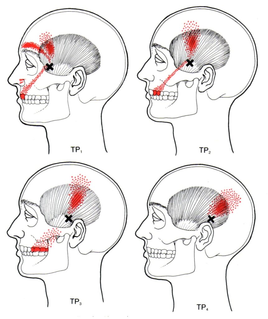 Jaw Trigger Point